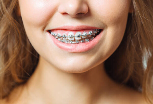 Breaking Down the Differences: Metal vs Ceramic Braces