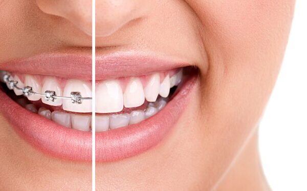 How Aesthetic Braces Can Boost Your Confidence and Transform Your Smile