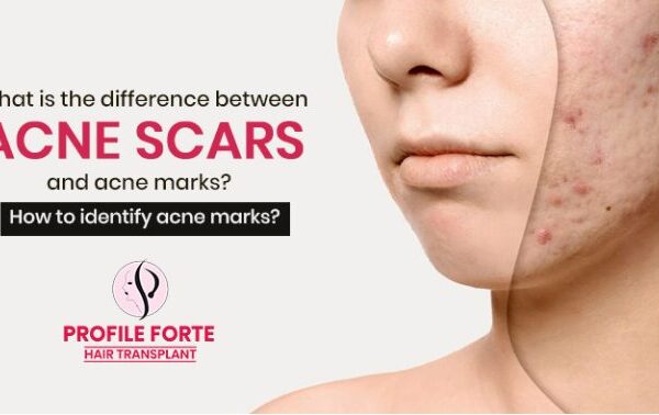 Understanding the Difference Between Acne Marks vs Acne Scars
