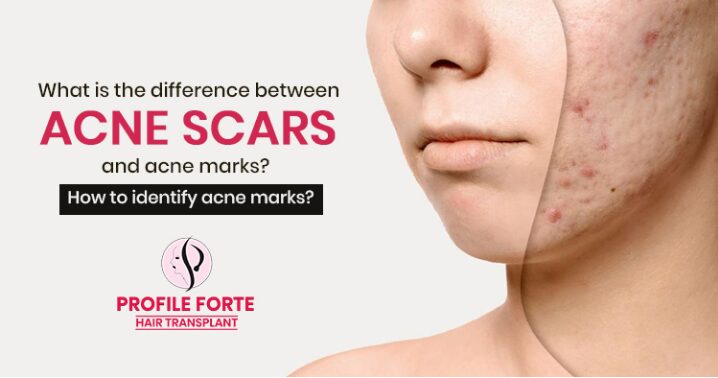 Understanding the Difference Between Acne Marks vs Acne Scars