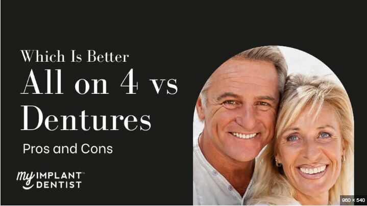 The Advancements and Benefits of All-on-Four Dental Implants