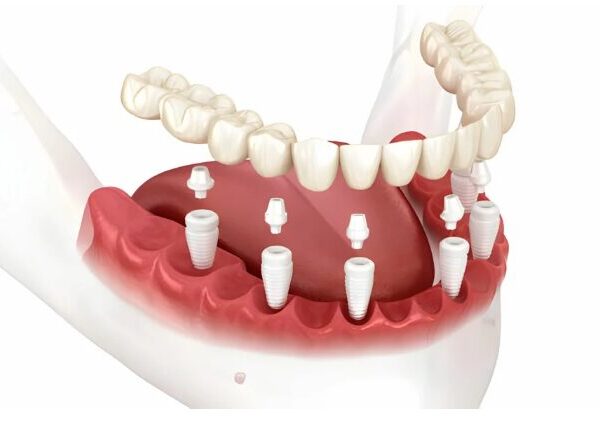 Step-By-Step Process of Getting Full-Mouth Dental Implants