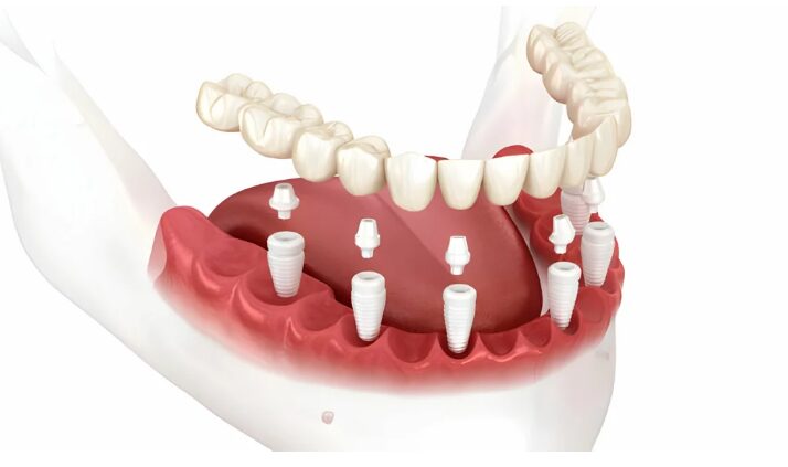 Step-By-Step Process of Getting Full-Mouth Dental Implants