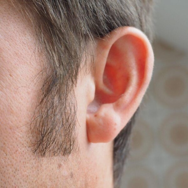 How Incisionless Otoplasty Is Revolutionizing Ear-Reshaping Procedures