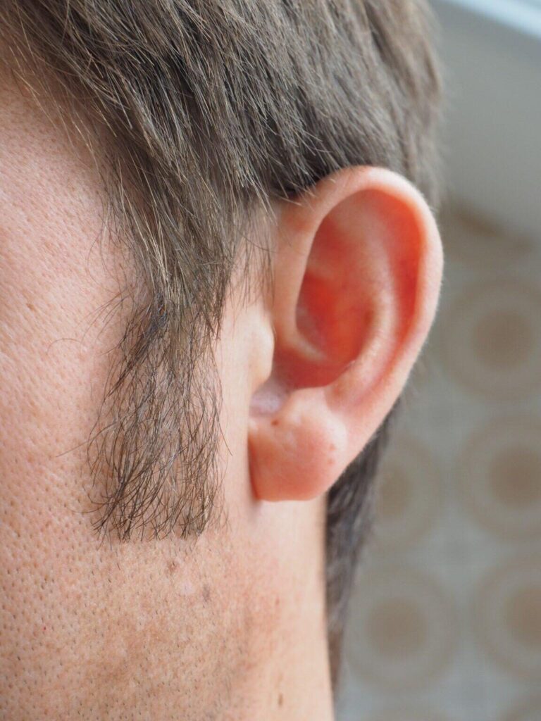 How Incisionless Otoplasty Is Revolutionizing Ear-Reshaping Procedures