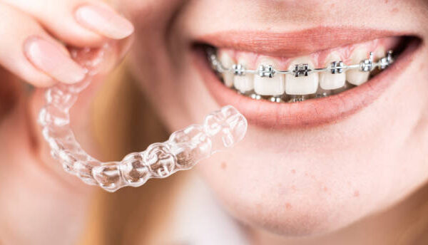The Ultimate Guide to Different Types of Braces