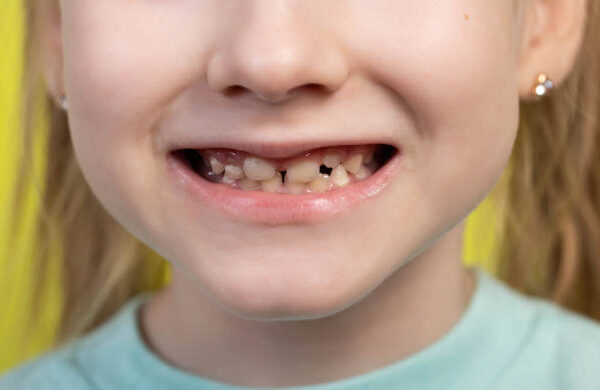 The Ultimate Guide to the Different Types of Crooked Teeth in Children