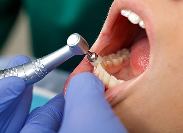 The Benefits of Regular Deep Dental Cleaning for Your Oral Health