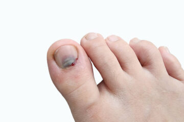 Ask your doctor about alternatives if DDR causes serious adverse effects like toenail loss. Other drugs or treatments may work as well without harming your nails.