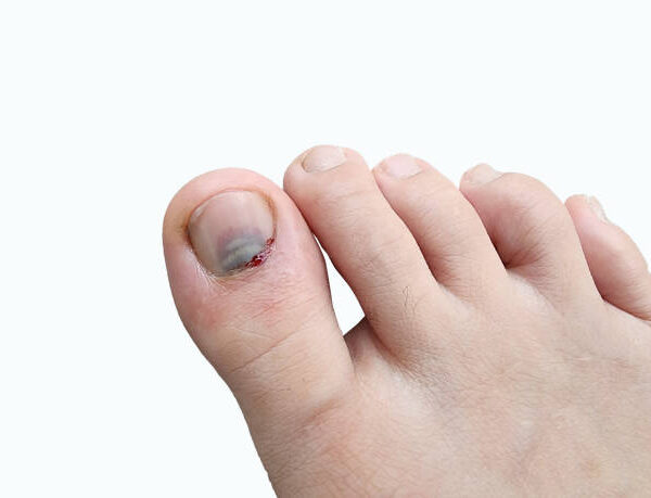 Ask your doctor about alternatives if DDR causes serious adverse effects like toenail loss. Other drugs or treatments may work as well without harming your nails.